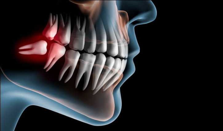 Wisdom Teeth Removal
