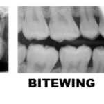 Dental X-Rays Explained