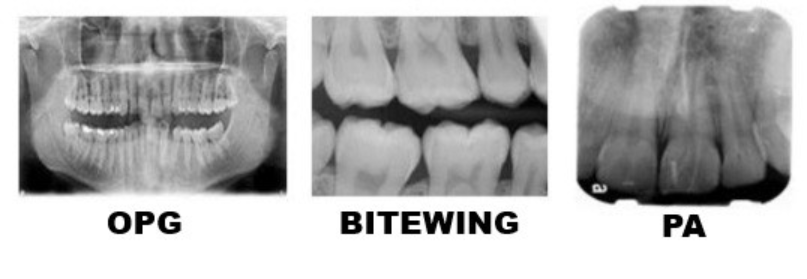 Dental X-Rays Explained